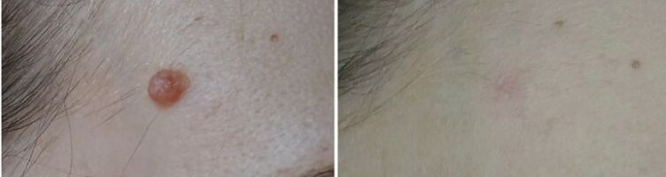 vor und nach Laser Papilloma Entfernung Foto 2