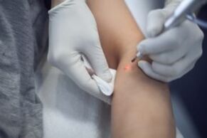 Laserbehandlung