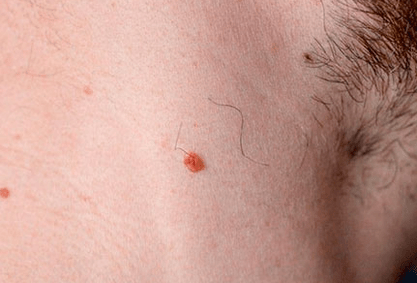 Papilloma