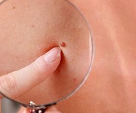 Manifestationen des menschlichen Papillomvirus