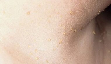 Risiko einer Papillomatose am Hals