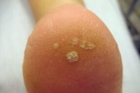 Plantarwarze