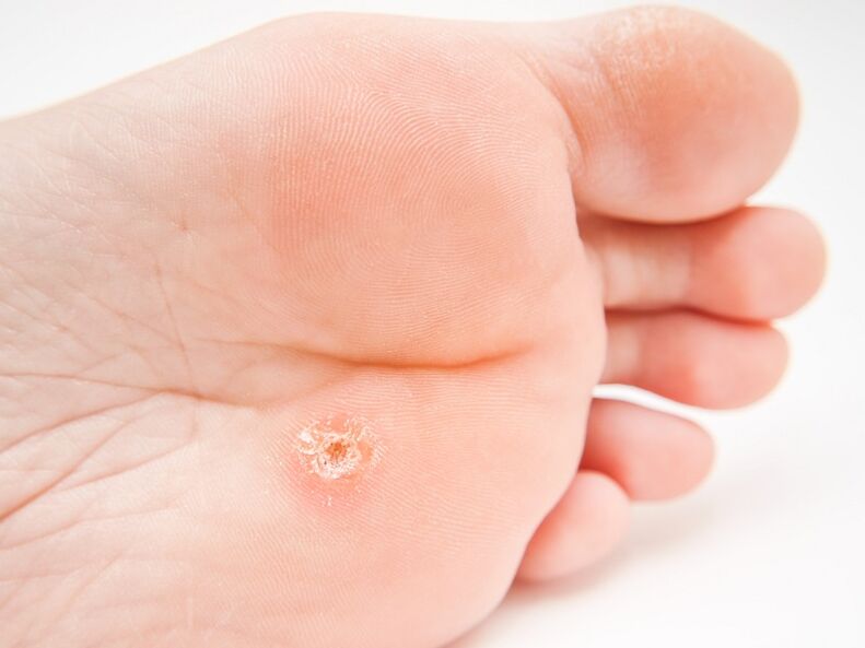 Plantarwarze am Fuß