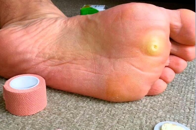 Plantarwarze am Fuß