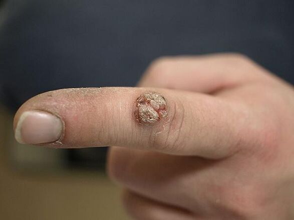 Papillom am Finger