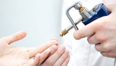 Kryodestruktion als Methode zur Behandlung von Warzen